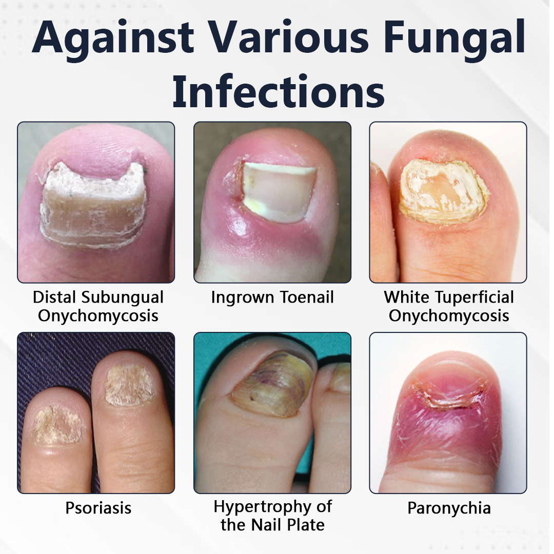 Ceoerty® NailFungiClear Pro Antifungal Pen