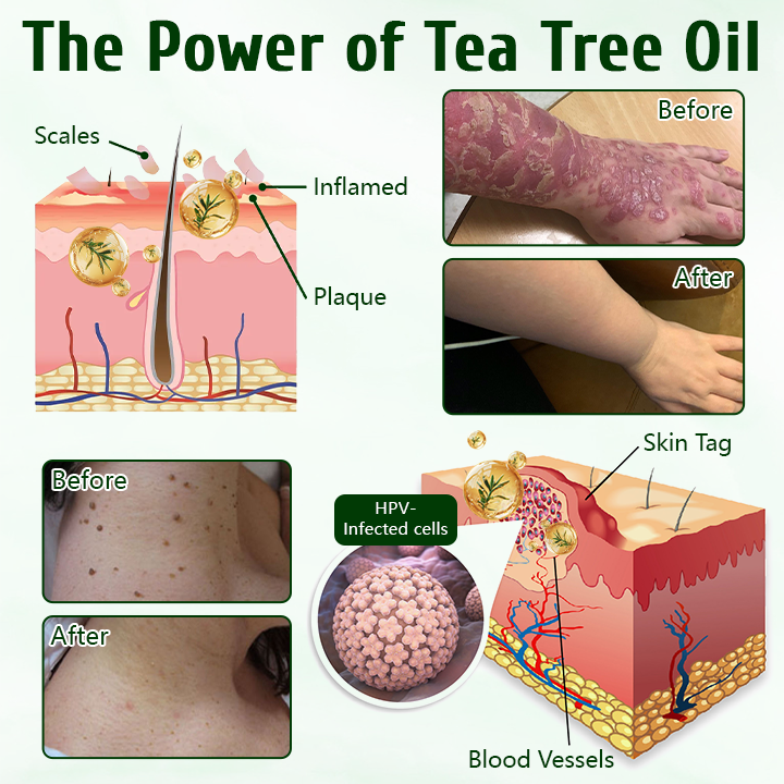 Timilk® DermaPure Tea Tree Healing Cream🔥