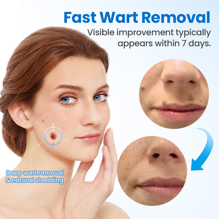 Timilk® TagGone Wart Removal Cream 🔥