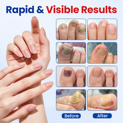 Biancat®Fungal Nail Repair Patches